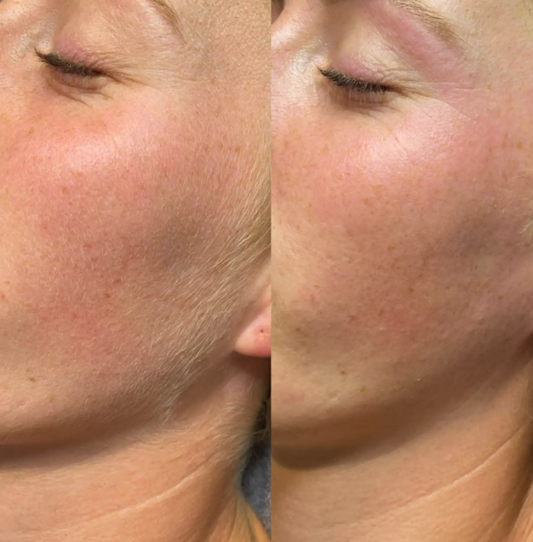 Is Dermaplaning Difficult to Do at Home?